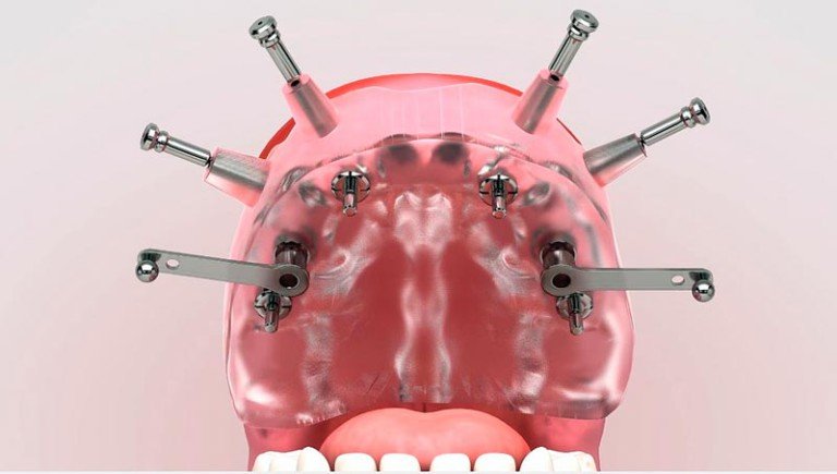 Modalidades de implantes dentales