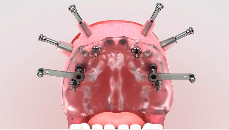 Modalidades de implantes dentales Modalidades de implantes dentales
