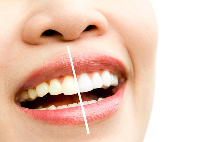 dientes blancos